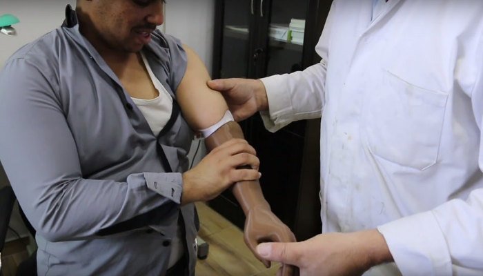 3d printed prosthetics syria