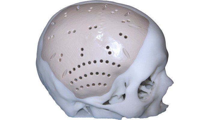 peek in the medical sector cranial implant