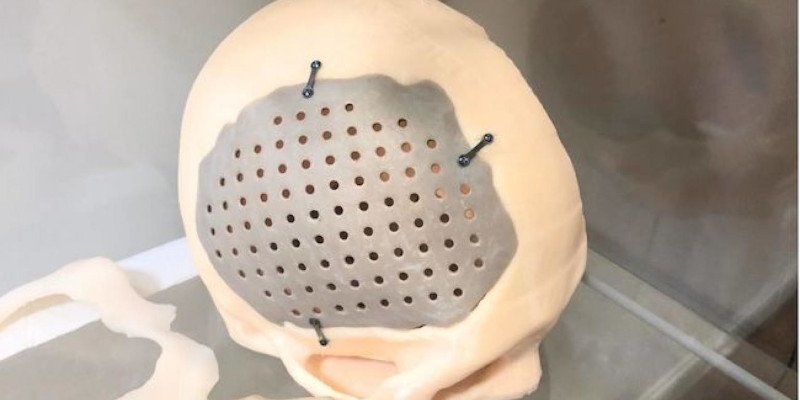 3d printed medical implant in a patient's skull