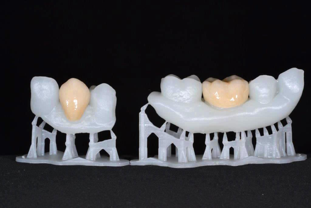 3d printed dental crown